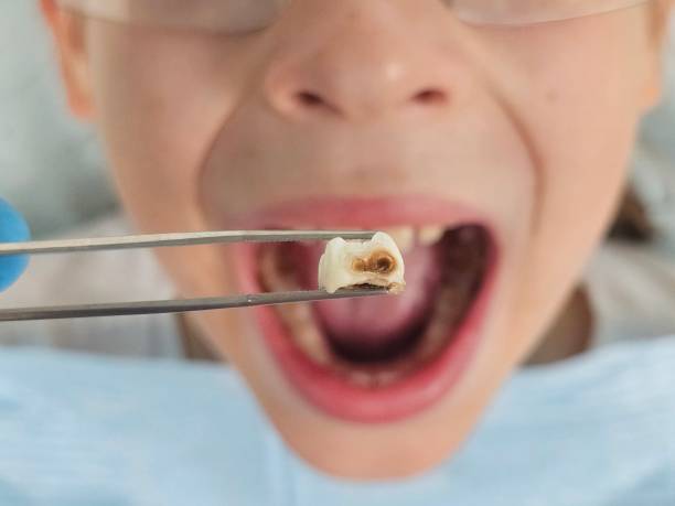 Best Knocked-Out Tooth (Avulsed Tooth) Treatment in St Marys, KS